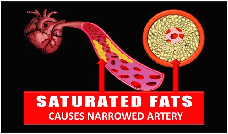 Saturated fats Causes Narrowed Artery